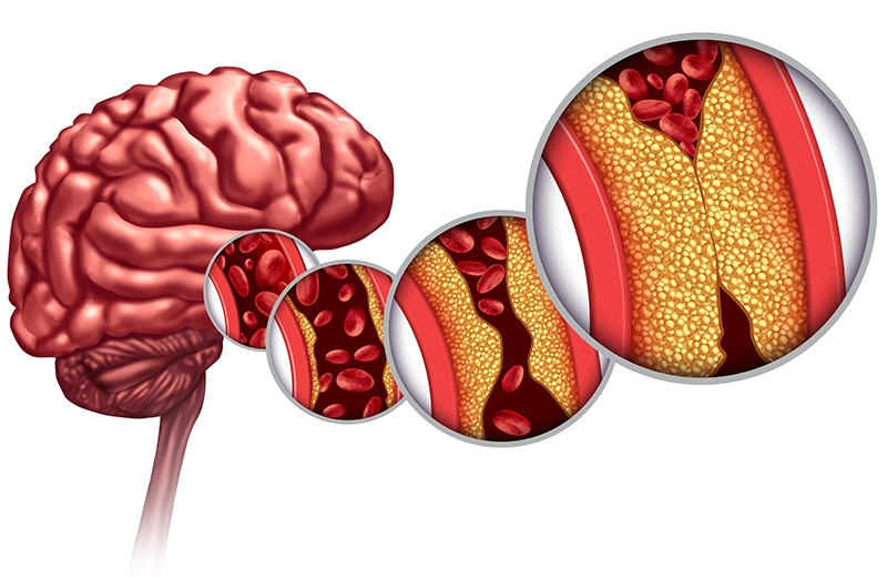 brain arteries