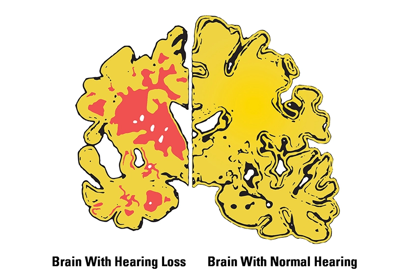 brain with and without hearing loss
