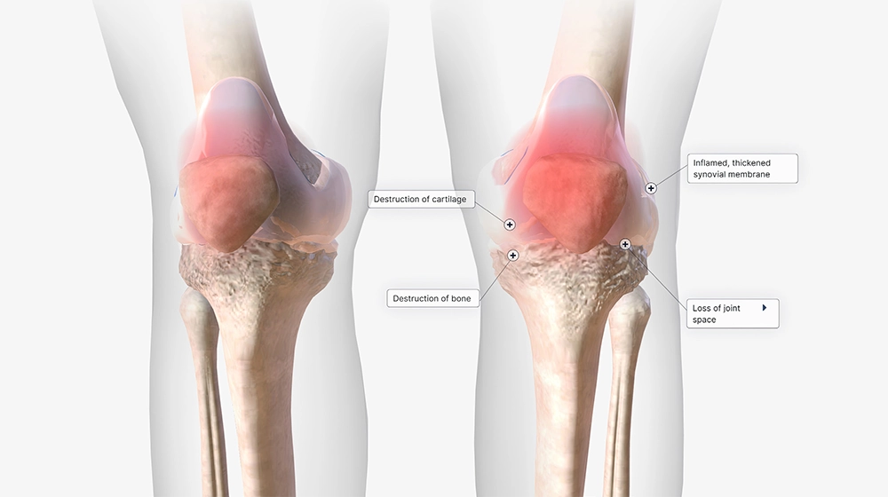 joint pain